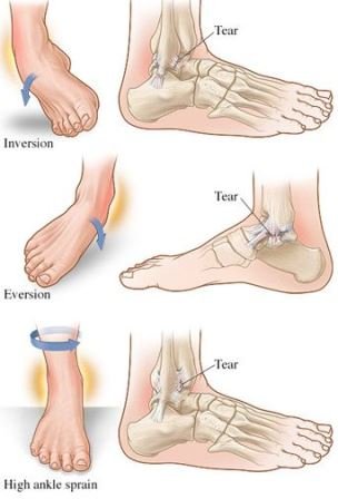 types of ankle sprains