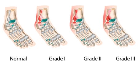 grades of ankle sprains